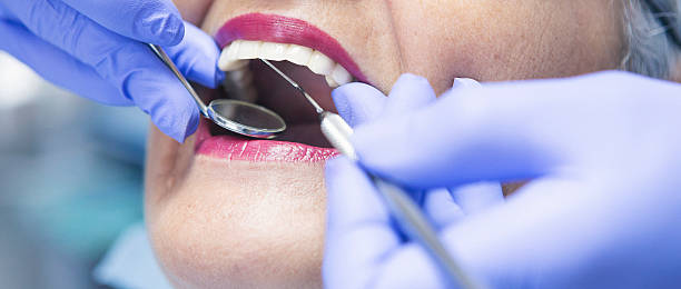 Best Knocked-Out Tooth (Avulsed Tooth) Treatment in Deltona, FL